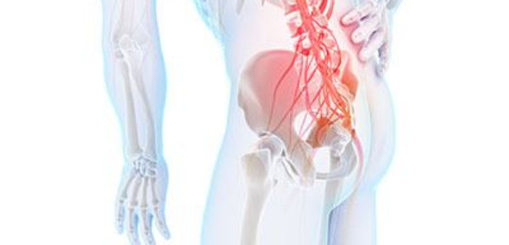 L’arthrose de la hanche - tout savoir