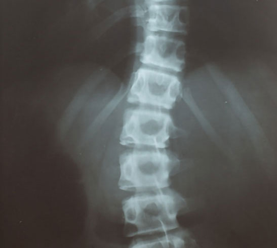 scoliose X Ray